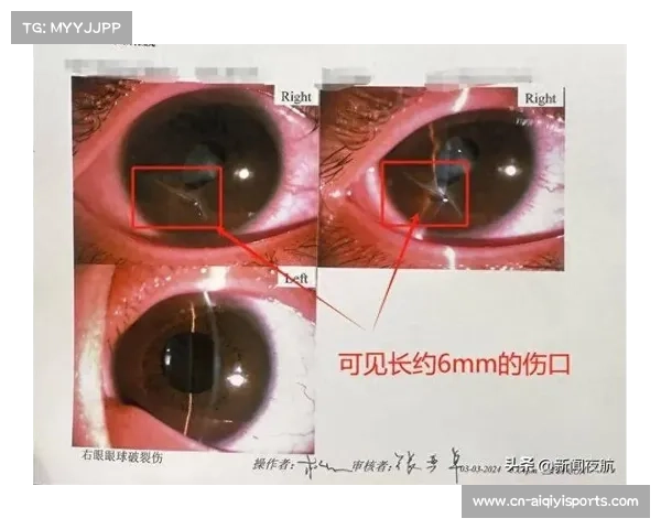 冠军视力受损，角膜擦伤需休养两月